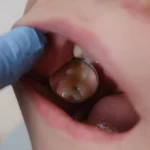 Why an Untreated Cavity Ends in Root Canals in Falls Church
